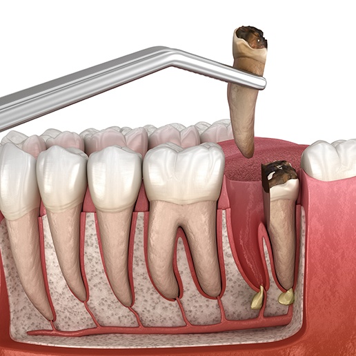 Rendering of a damaged molar being extracted