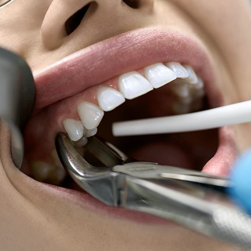 Closeup of woman having tooth removed with forceps