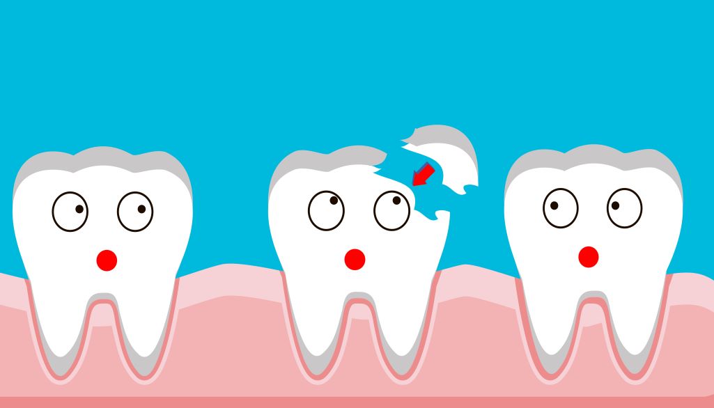 A cartoon image of a chipped tooth